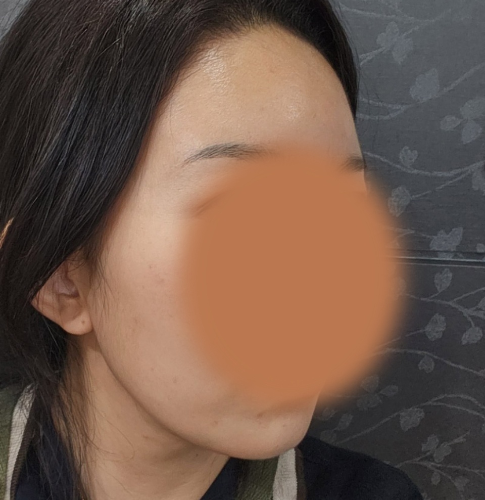이중턱지방흡입, 지방이식 잘된 후기~~