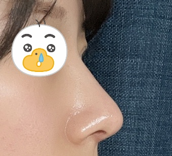 무보형물코수술 4달째네용~!