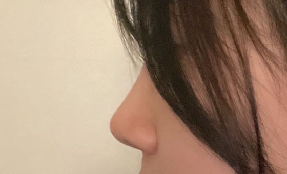 코수술 한달차:)