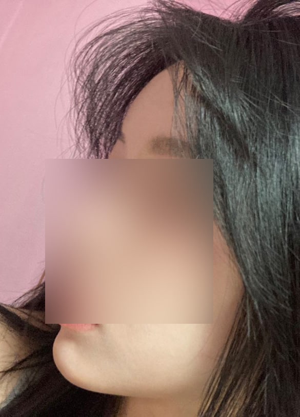 지방이식 한달째인데 생착률 미쳤다