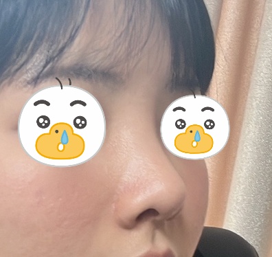 낮은코, 펑퍼짐한 코 이별~.~