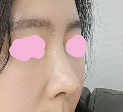 코랑 눈재수술한지 6개월이 지났습니다^^