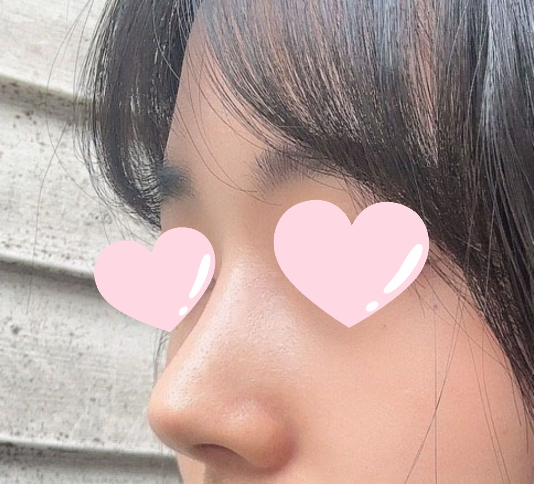 복코수술 3개월차! 예쁨예쁨