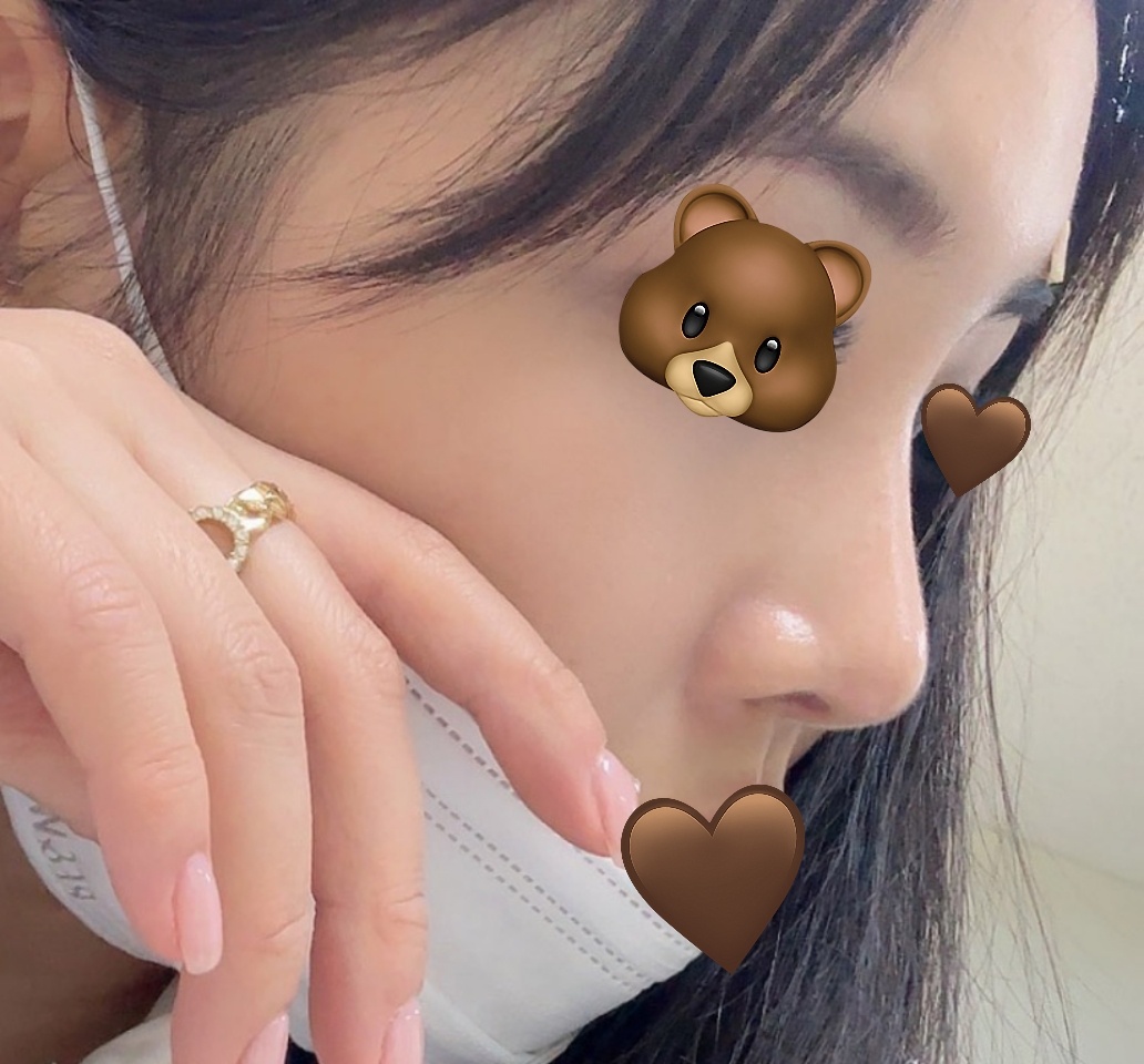 기능코성형 5개월됐어욥