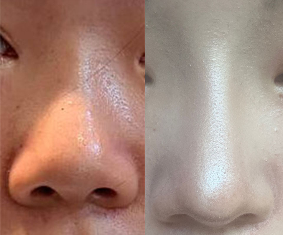 2._수술전후_정면_-코.jpg