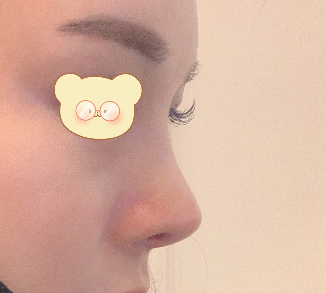 오래전 코수술하고 다시 재수술!