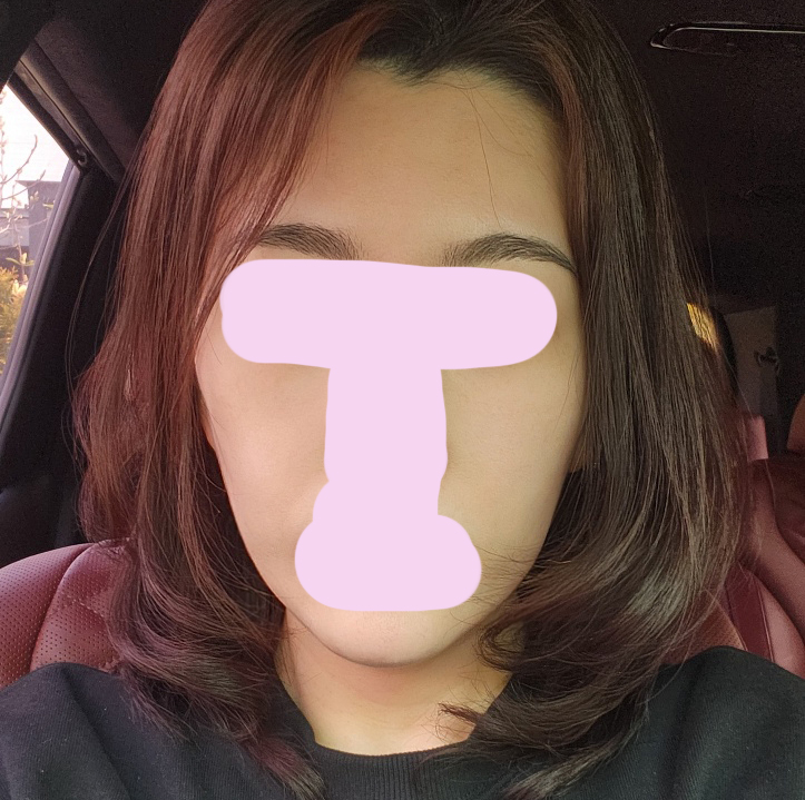 안면거상술한지 5개월지났어요~~