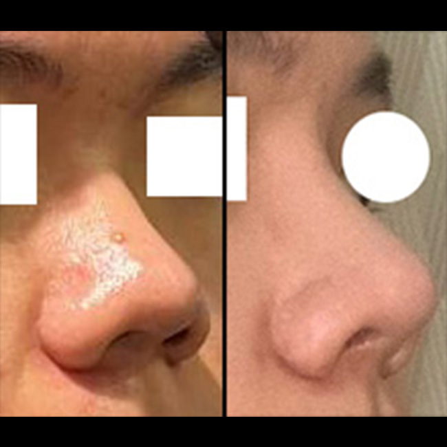 코성형 매우 만족중입니다 감사합니다!