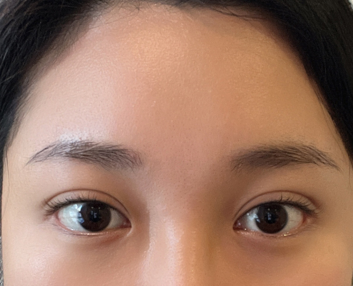 눈매교정&이마거상&얼굴지방흡입 6개월차입니당