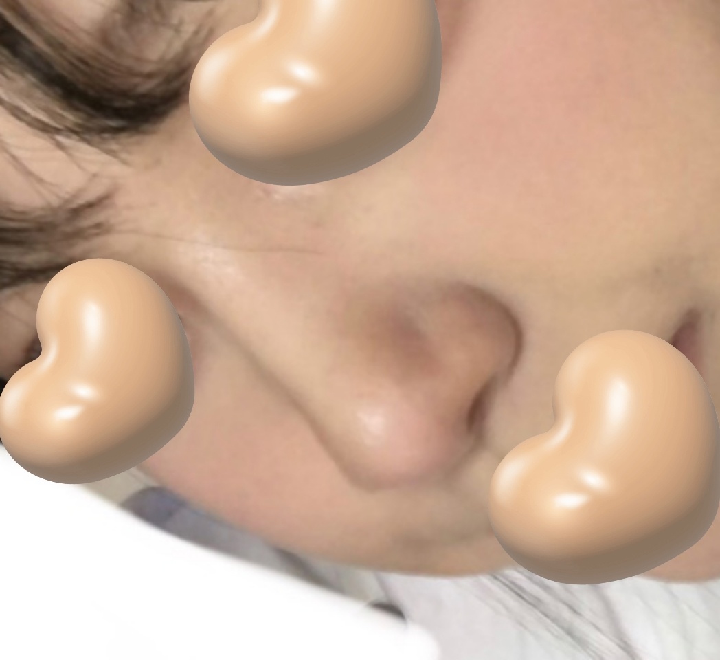 유영문원장님께 눈, 코 받은지 4개월지났슴당