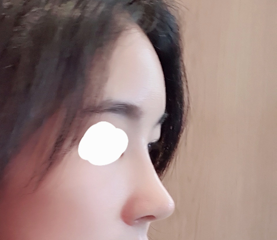 코+지방이식 추천bb