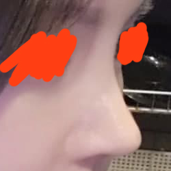 자가늑 코재수술 후기!