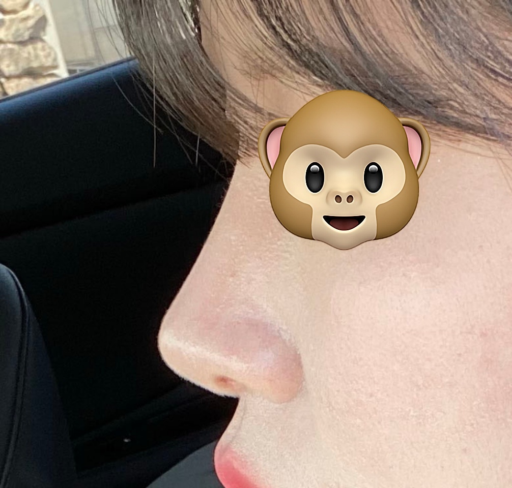 눈재+코수술 6개월지났습니당