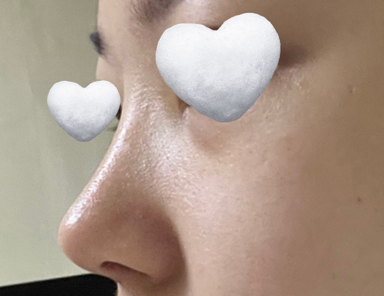 망고트임이랑 코수술 했어요ㅎㅎ