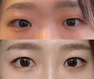 눈 예쁘게 잘됐어요!-4개월차