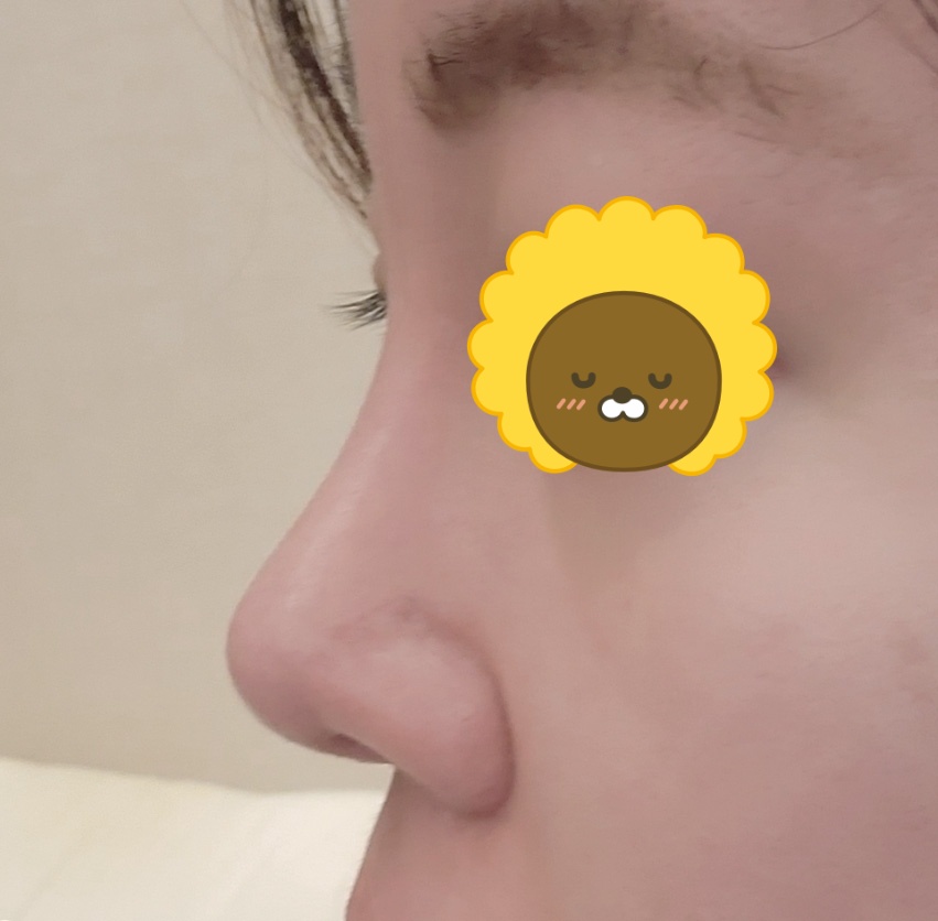 어느덧 수술5개월차..바이브 유원장님 적극추천!