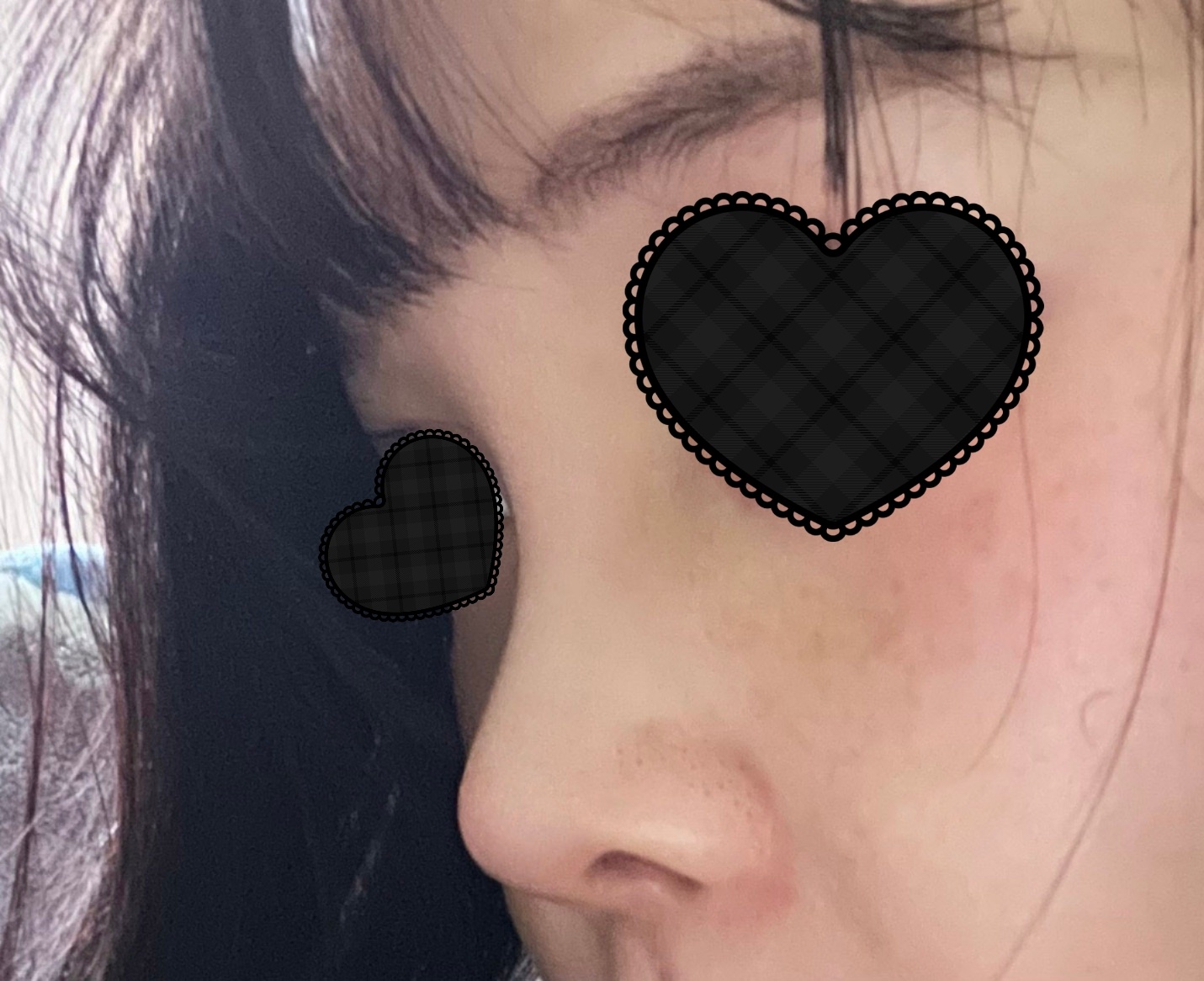 낮은코성형 만족후기입니당:)