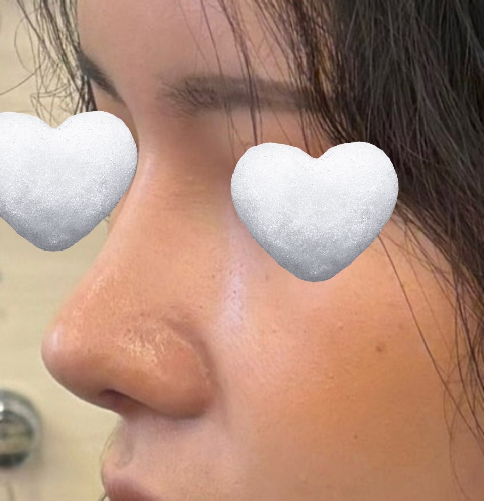 유영문원장님께 코수술 받았어요(3주차후기)