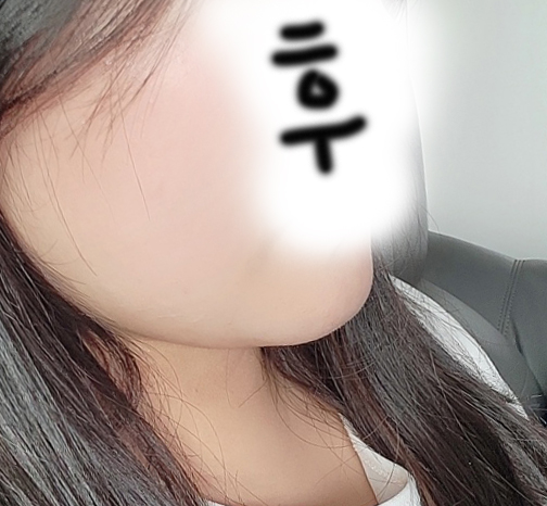 이중턱소멸됐어요!!ㅎㅎ