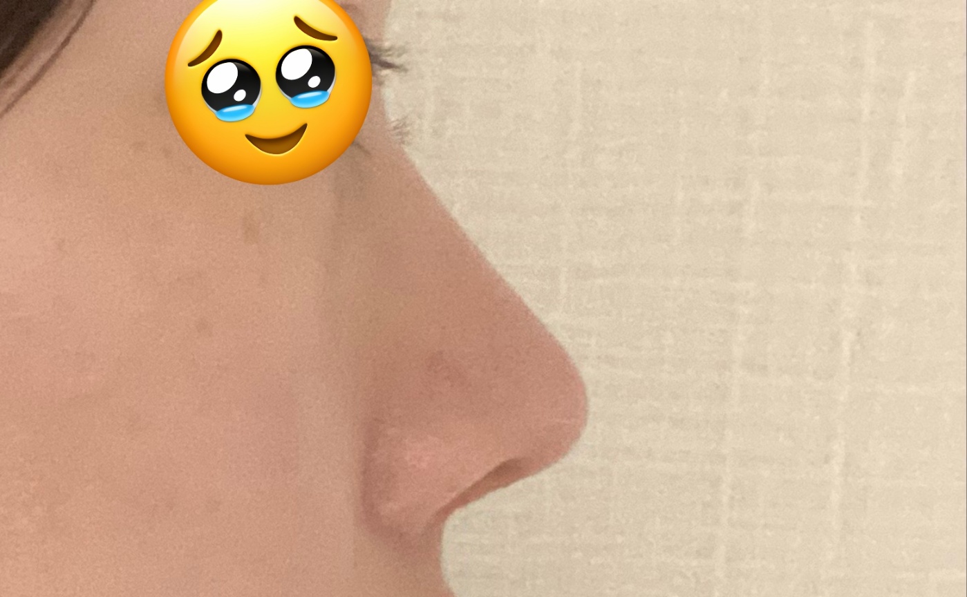 코재수술 완전 만족입니당~~