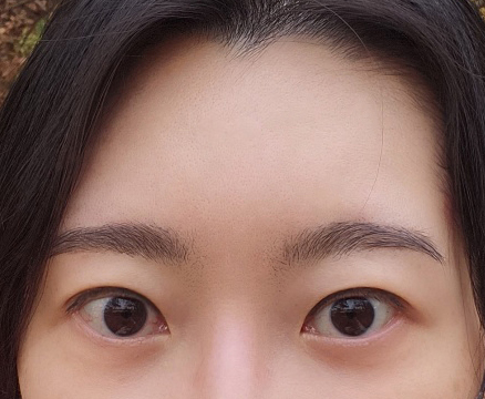 눈성형+이마거상 결과만족해요