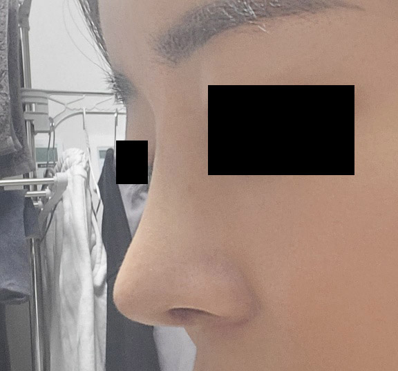 바이브 유영문원장님께 수술받은지 2달차