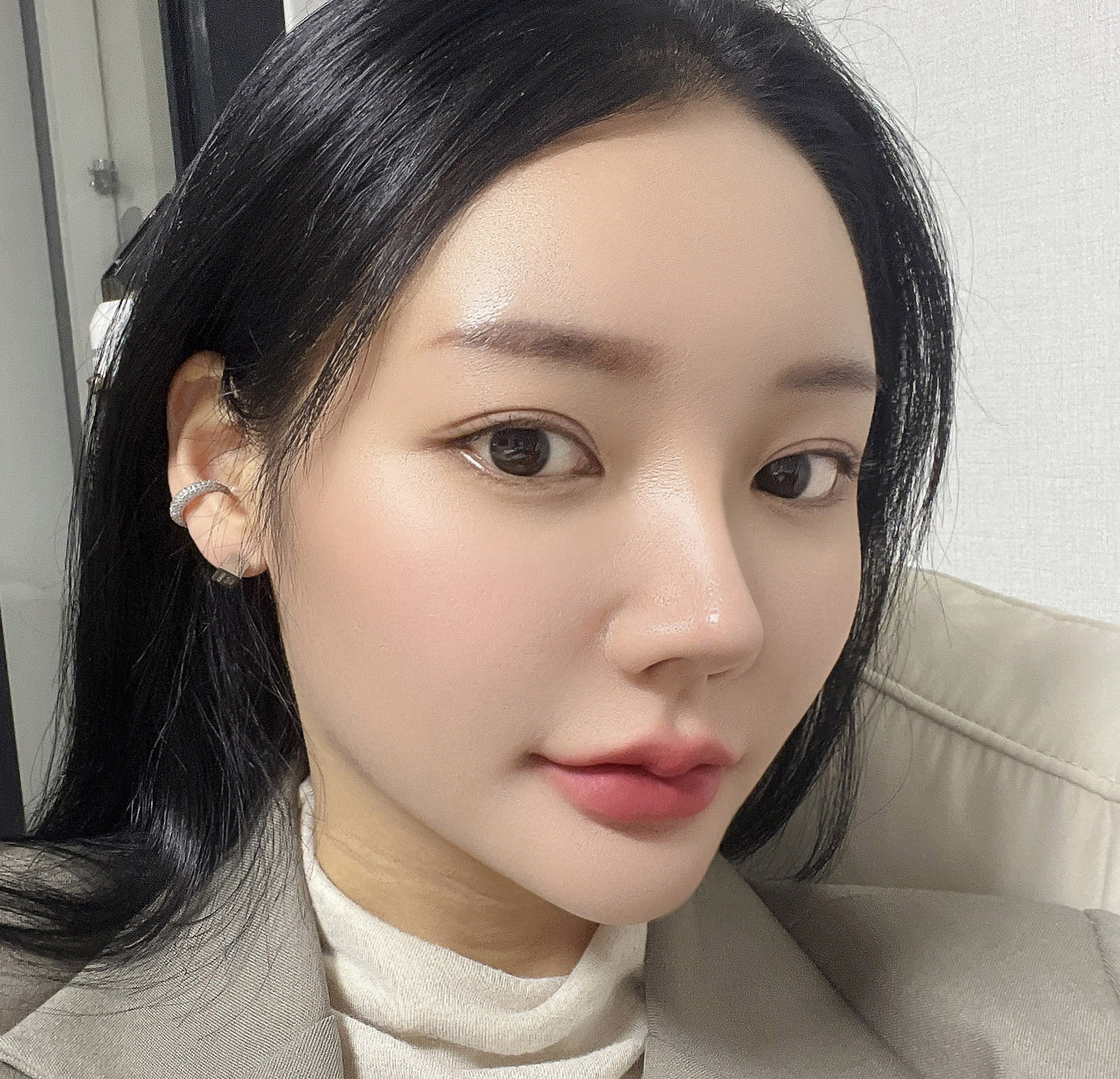 눈, 코재수술 7개월차! 자리 제대로 잘 잡았어용