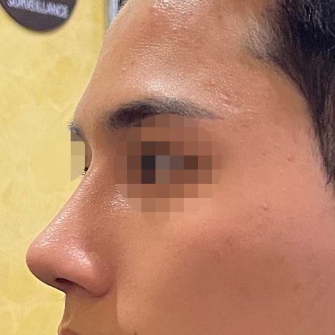 남자코성형 후기입니다