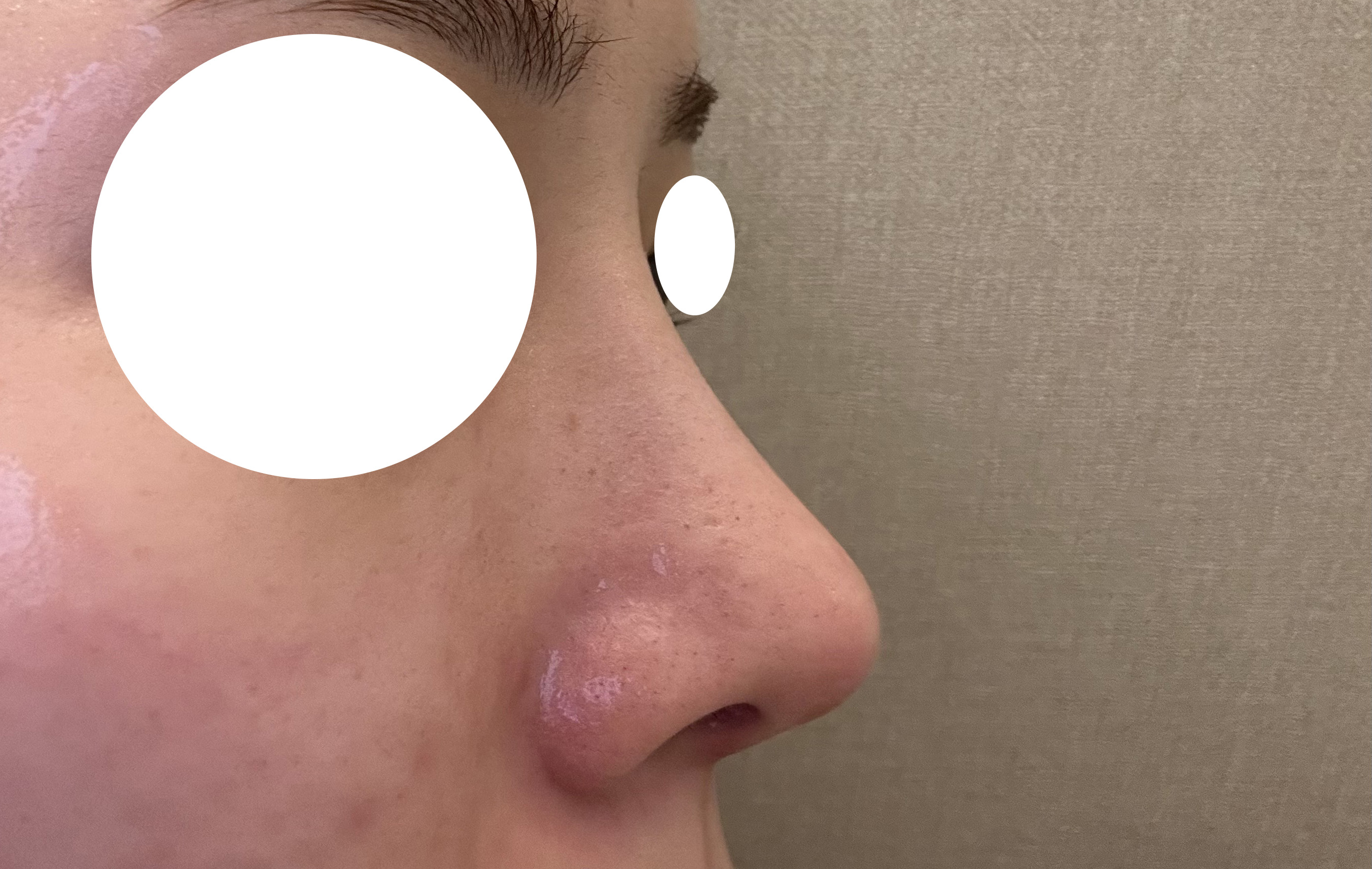 복코수술했어욤 ㅎㅎ