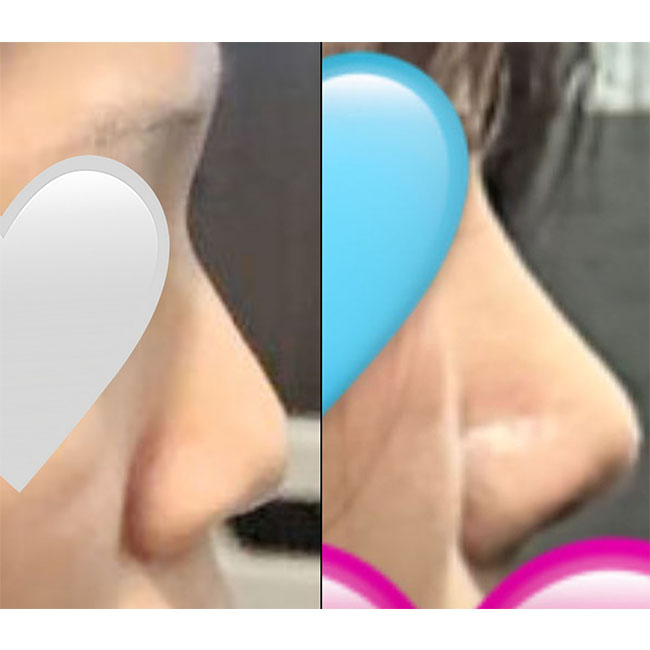 코수술잘돼서 주변에서 바이브 하겠다네욤ㅎㅎ