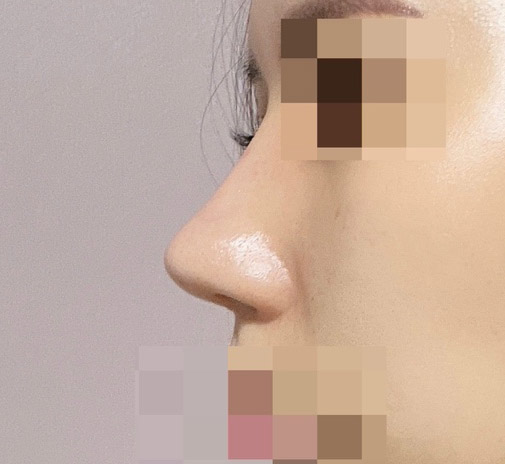 자가늑코재수술!!원하던 코에요!