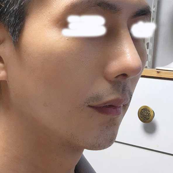 눈,코 무턱보형물 수술하고선 자신감이 넘쳐납니다.