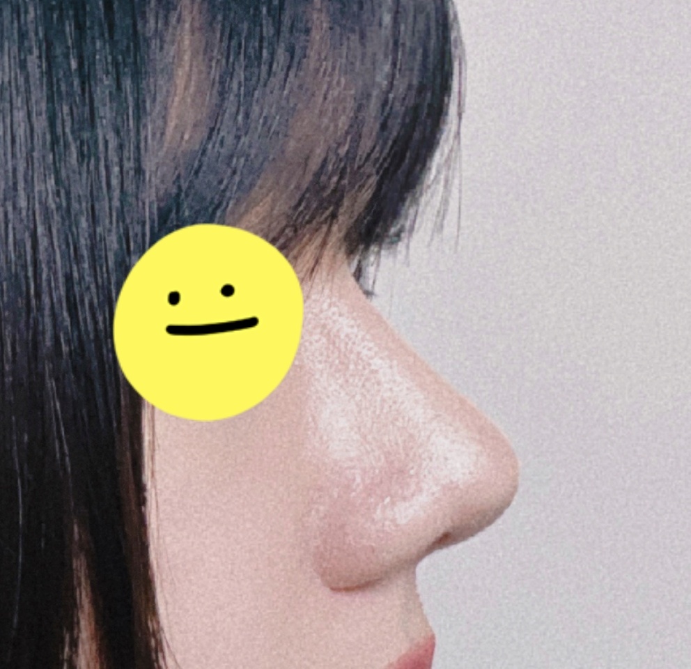 눈,코수술 전후사진이랑 후기올려요! ㅎㅎ