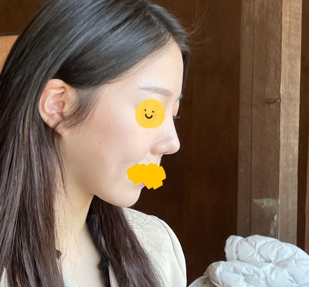 코수술4개월차입니당 다들 친절친절!!