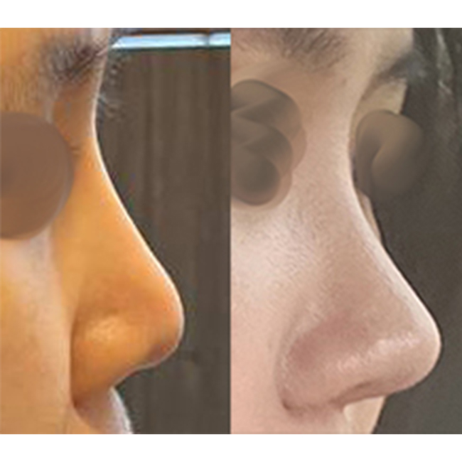 바이브에서 후회없는 코재수술했습니다:)