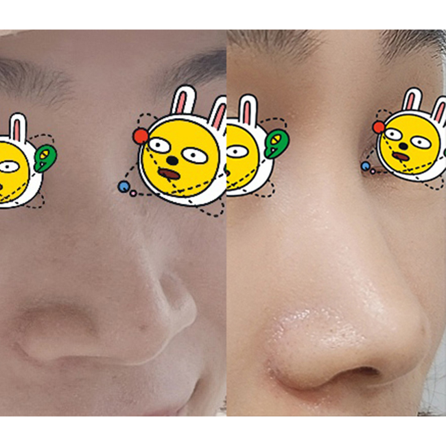 콧볼축소 너무나 만족합니다~~