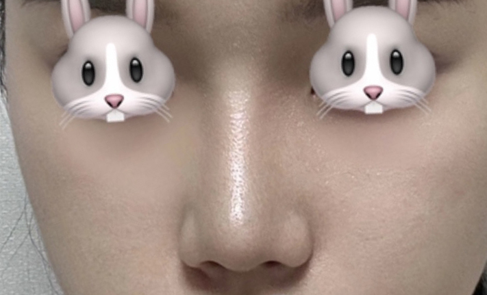 붓기도 많이 빠지고 모양만족!!-코수술3달차