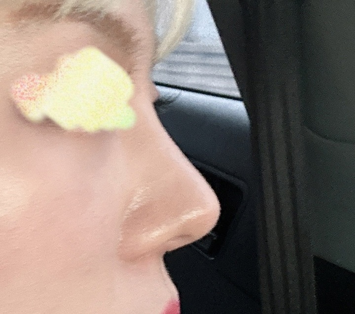 코재수술 7개월차입니다:)