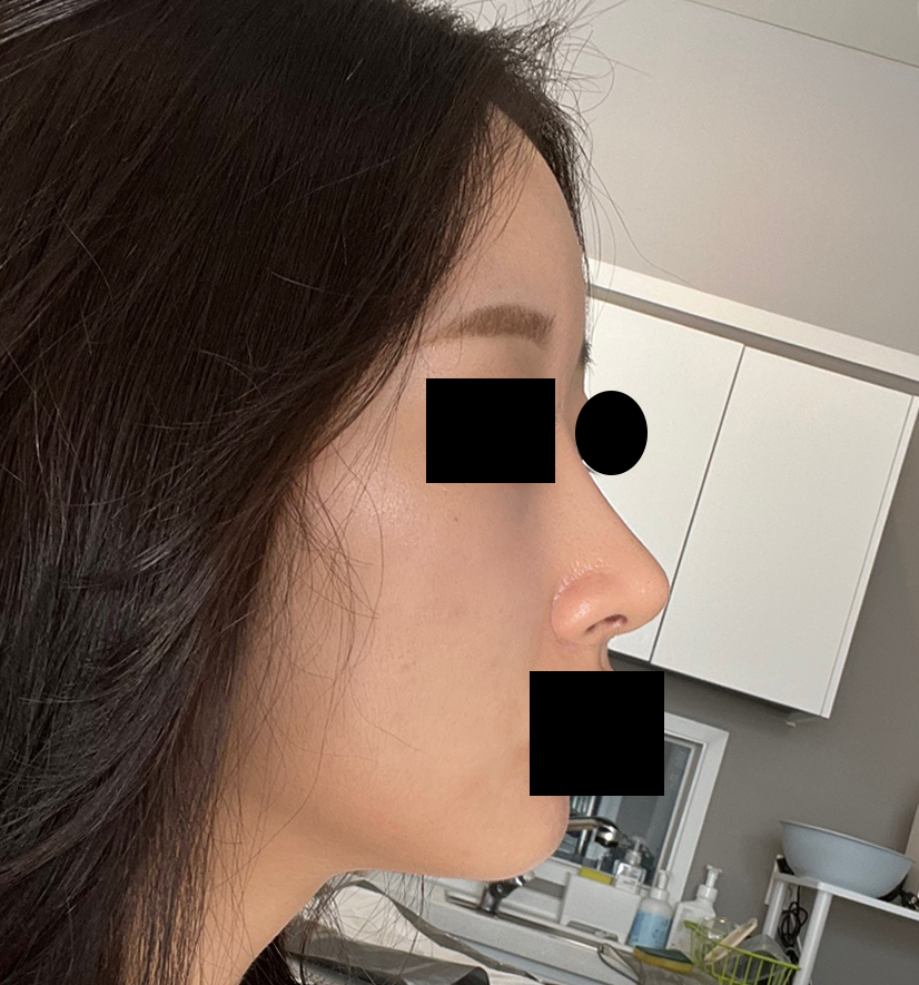 첫코, 풀페이스지방이식수술 5개월차됐어요!