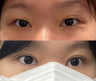 쌍꺼풀라인 맘에 들어용