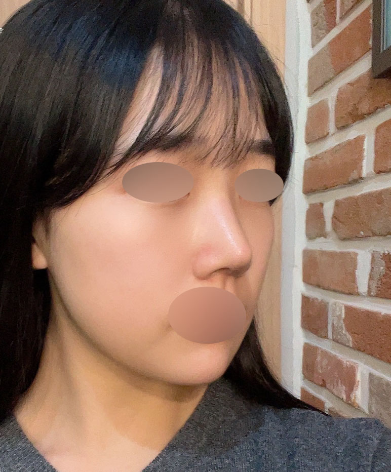 수술후_3_-코.jpg