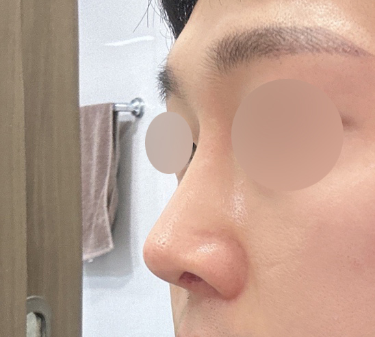 코수술 바이브 유원장님 적극 추천합니다!