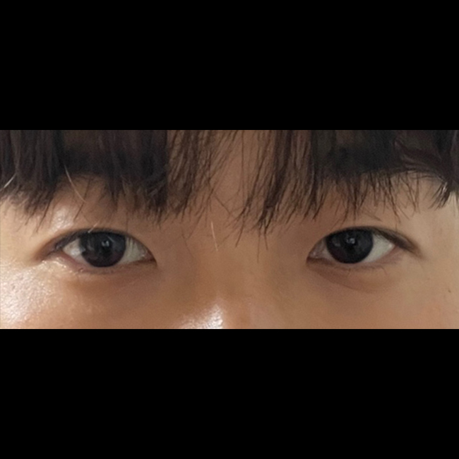 눈매교정 자연스럽게 잘됐습니다!