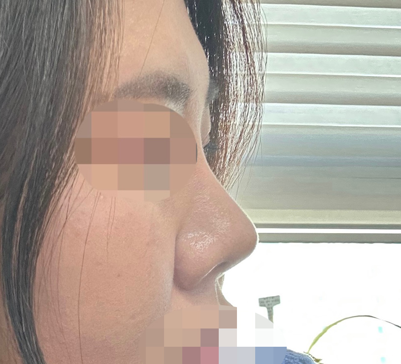 코재수술 4개월됐습니다~