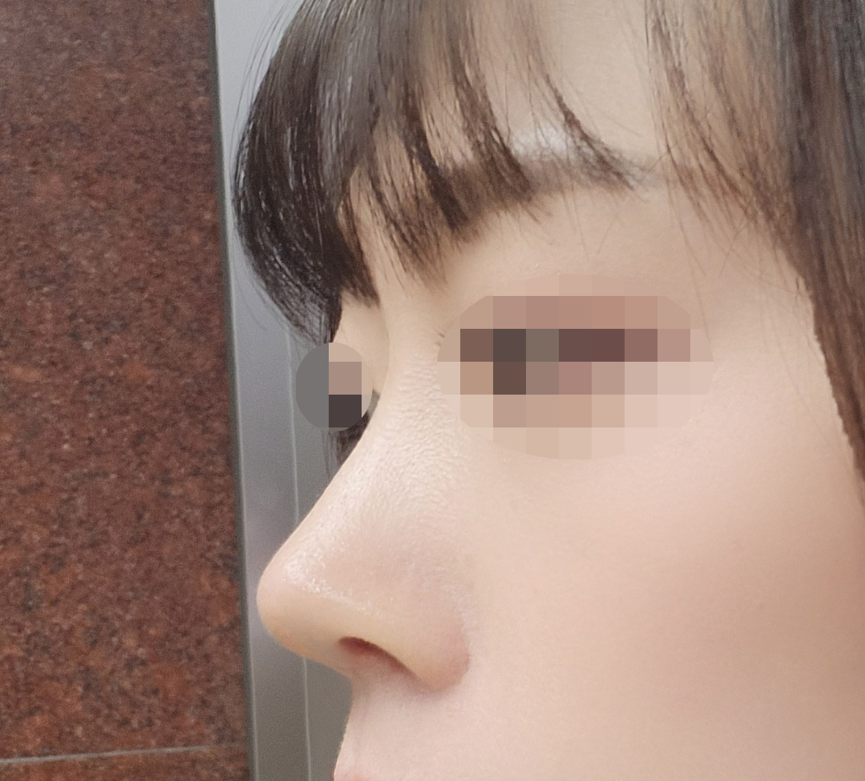 코성형 한달차 후기올려욥