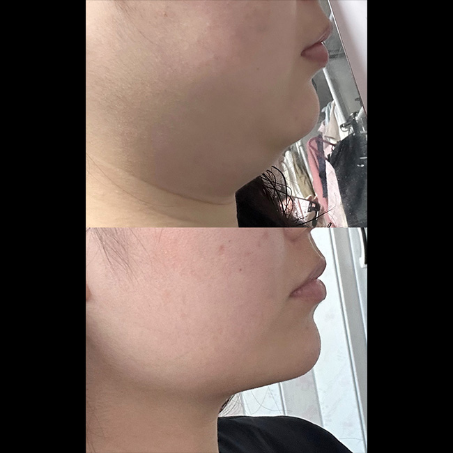 얼굴지방흡입 효과 완전 GOOD!!!