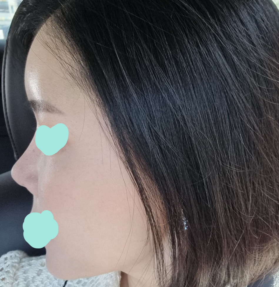 바이브에서 수술후 후기씁니다^^