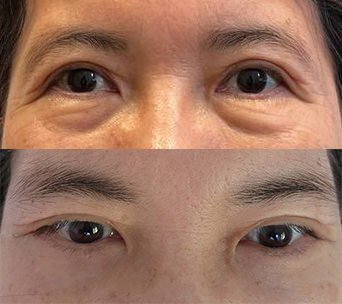 이번에 하안검눈성형을 하게 됐습니다