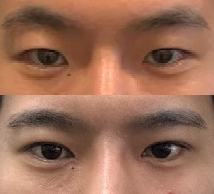 남자눈성형 바이브 유원장님 강추드립니다.