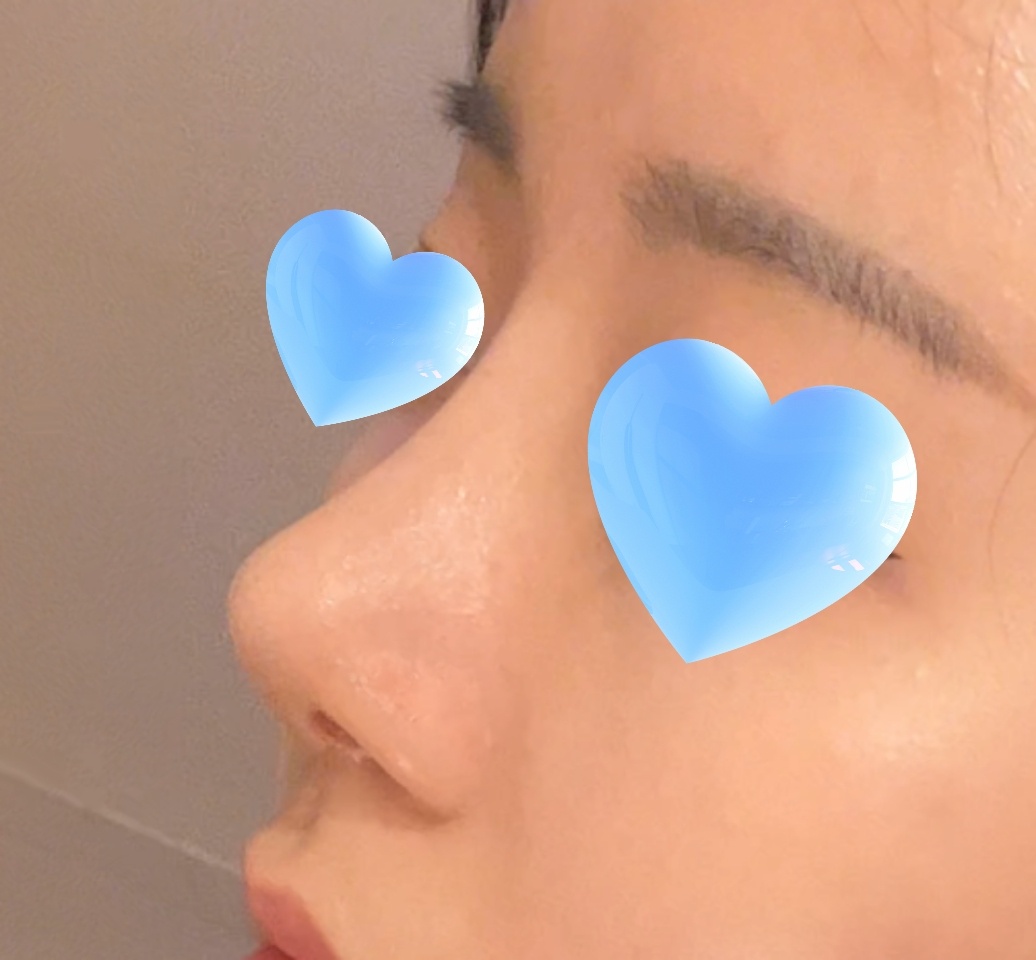 복코성형 완전 대만족 하는중!!